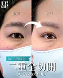 二重全切開(たるみとり併用)による目元整形 before画像 サムネイル用