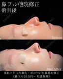 他院修正鼻フル before画像 サムネイル用
