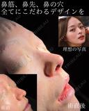 他院修正鼻フル 1日後 サムネイル用