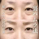 切らないクマ取り(裏ハムラ法) before画像 サムネイル用