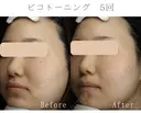 ピコトーニング before画像 サムネイル用