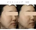 ピコトーニング after画像 サムネイル用