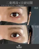 二重埋没（クロスナチュラル・４点線留め）＋目頭切開 after画像 サムネイル用