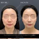 リバー式小顔脂肪吸引 before画像 サムネイル用