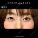 目の下の切らないクマ取り 30日後 サムネイル用
