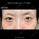 目の下の切らないクマ取り before画像 サムネイル用