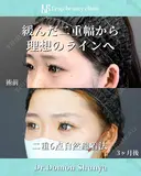 Leap式6点自然癒着法で理想の二重ラインに 90日後 サムネイル用