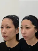 糸リフト 0日後 サムネイル用