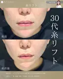 糸リフト before画像 サムネイル用