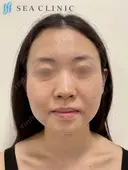 SEAライン ‐３D脂肪吸引（頬・顎）‐・メーラーファット・糸リフト before画像 サムネイル用