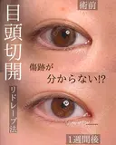 目頭切開 after画像 サムネイル用