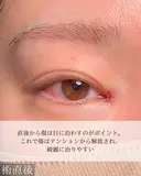 目頭切開 after画像 サムネイル用