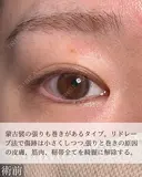 目頭切開 before画像 サムネイル用