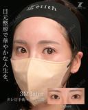 タレ目手術の症例紹介です。 90日後 サムネイル用