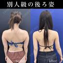 シークレット脂肪吸引二の腕 30日後 サムネイル用