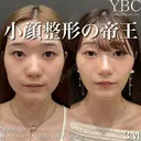 【🦒1dayVライン3D脂肪吸引🦒】 after画像 サムネイル用