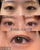目頭切開 二重埋没 30日後 サムネイル用