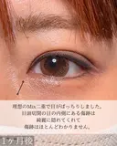 目頭切開 二重埋没 30日後 サムネイル用
