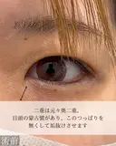 目頭切開 二重埋没 before画像 サムネイル用