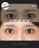 自然癒着法 30日後 サムネイル用