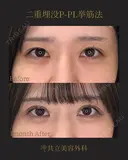 共立式二重埋没P-PL挙筋法 before画像 サムネイル用