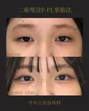 共立式二重埋没P-PL挙筋法 before画像 サムネイル用