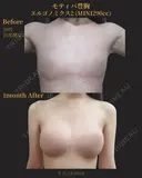 バック豊胸｜モティバ エルゴノミックス(エルゴノミックスタイプ) before画像 サムネイル用