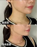 Dr都築⭐️スネコス注射⭐️ before画像 サムネイル用