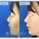 鼻尖形成3D＋鼻尖部軟骨移植＋鼻中隔延長＋プロテーゼ＋小鼻縮小(flap法) after画像 サムネイル用