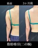 二の腕の脂肪吸引 before画像 サムネイル用