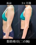 二の腕の脂肪吸引 before画像 サムネイル用