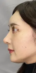 耳介軟骨移植＋鼻尖形成＋プロテーゼ 30日後 サムネイル用