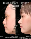 耳介軟骨を使用した鼻整形 after画像 サムネイル用