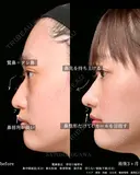 耳介軟骨を使用した鼻整形 after画像 サムネイル用