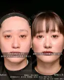 耳介軟骨を使用した鼻整形 before画像 サムネイル用