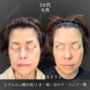 ヒアルロン酸注射/くま・頬・目の下・リップ・顎 before画像 サムネイル用
