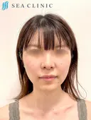 SEAライン3D脂肪吸引(頬・顎下)/メーラーファット/糸リフト6本   before画像 サムネイル用