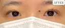 二重埋没法（線留め） after画像 サムネイル用