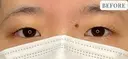 二重埋没法（線留め） before画像 サムネイル用