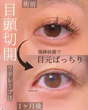 目頭切開 30日後 サムネイル用