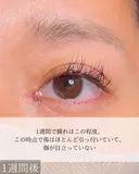 目頭切開 30日後 サムネイル用