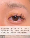 目頭切開 before画像 サムネイル用
