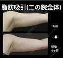 二の腕全体脂肪吸引 before画像 サムネイル用
