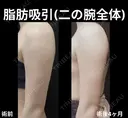 二の腕全体脂肪吸引 30日後 サムネイル用