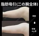 二の腕全体脂肪吸引 30日後 サムネイル用