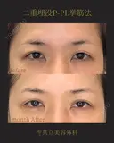 共立式二重埋没P-PL挙筋法 before画像 サムネイル用