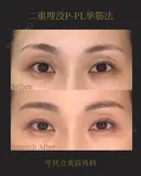 共立式二重埋没P-PL挙筋法 before画像 サムネイル用