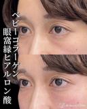 ベビーコラーゲン注射 before画像 サムネイル用