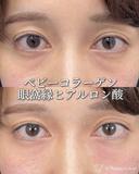 ベビーコラーゲン注射 after画像 サムネイル用