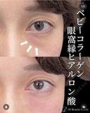 ベビーコラーゲン注射 after画像 サムネイル用